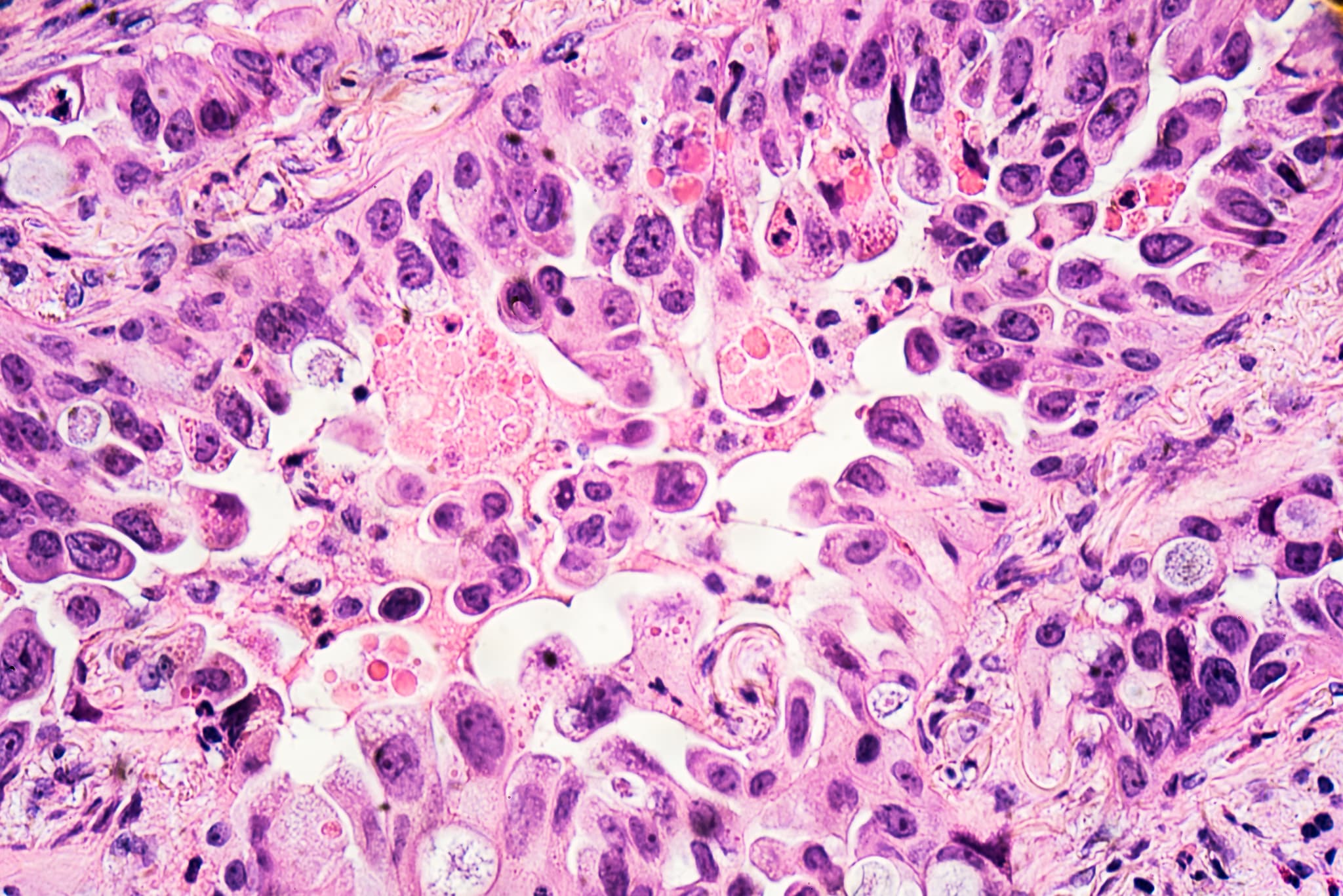 Lung cancer cells viewed with a microscope.