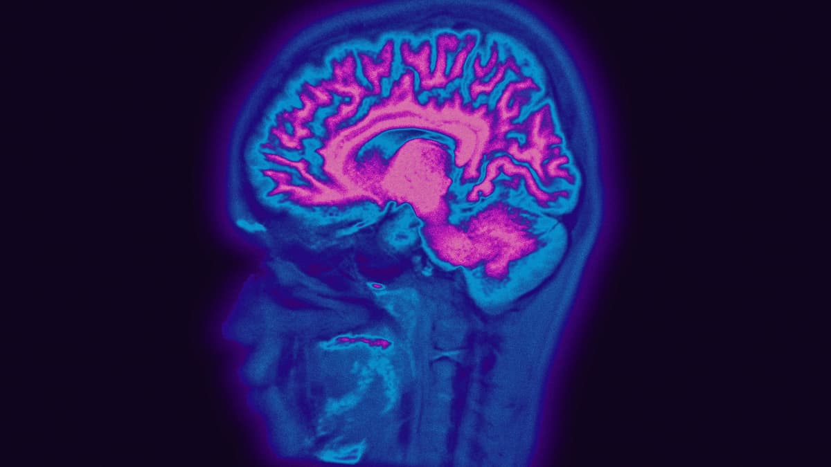 Image of a child's MRI brain scan.